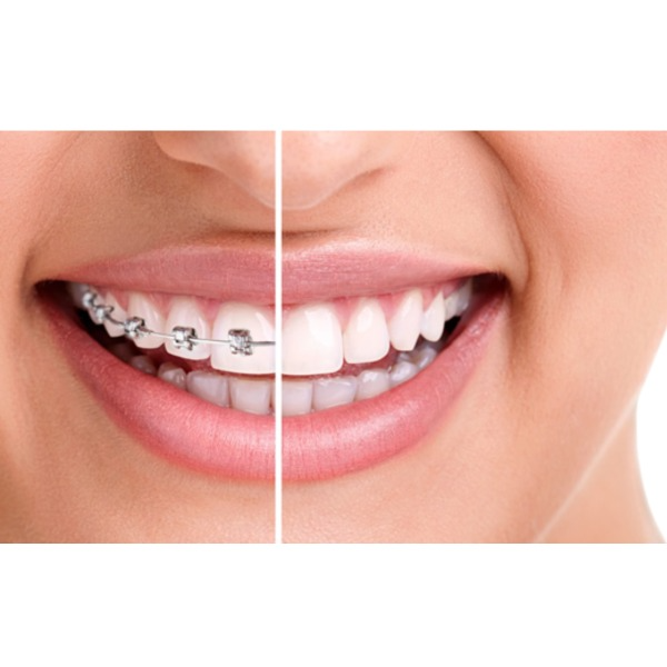 Orthodontic treatment