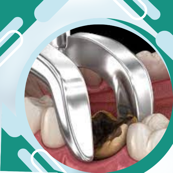 Surgical Removal of Teeth