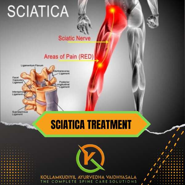 SCIATICA TREATMENT