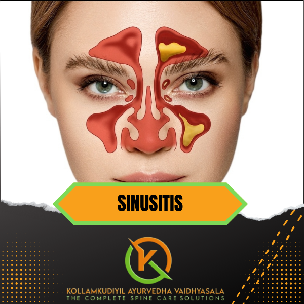 SINUSITIS TREATMENT