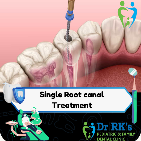 Single Root canal Treatment