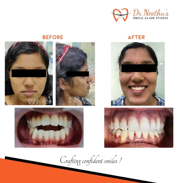 Open bite case managed with orthodontic braces!