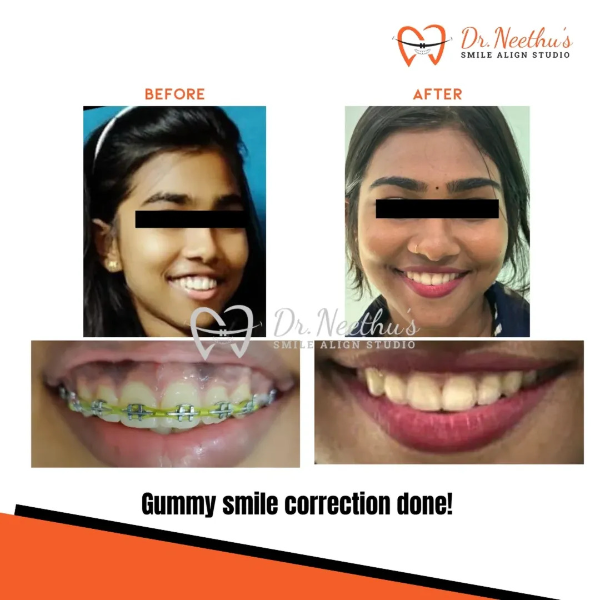 Gummy smile correction results! Witness the transformation